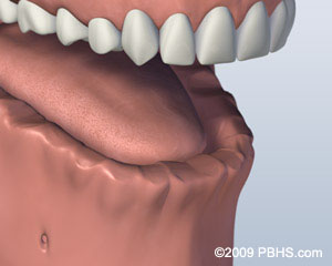 Lower Jaw All Teeth Missing Before Bar Attachment Denture