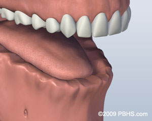 Lower Jaw All Teeth Missing Before Screw Attachment Denture