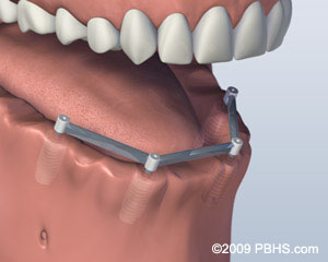 Lower Jaw All Teeth Missing with Four Implants for Bar Attachment Denture