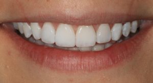 Porcelain Veneers Vs. Crowns Smile Designs of Olney