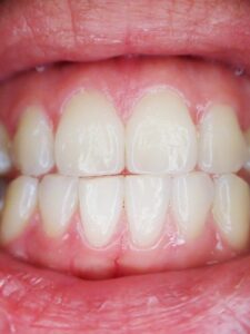 Laser Gum Surgery in Olney, MD