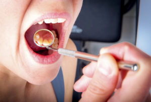 Fillings Smile Designs of Olney