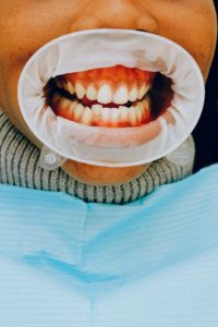 Dental X-rays Smile Designs of Olney