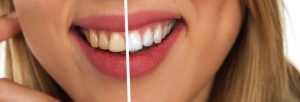 Signs That Your Teeth Dental Health Could Be Better Healthier Smile Designs of Olney